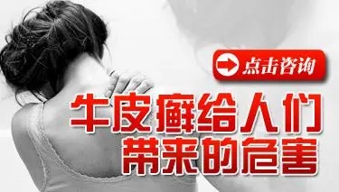 得了牛皮癣会怎么样